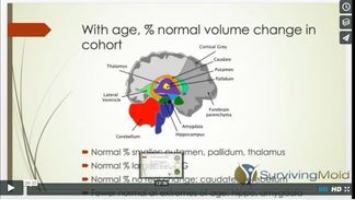 2016 Third Annual Conference Irvine, CA - Ritchie Shoemaker, MD -Multinuclear Atrophy and NQ 